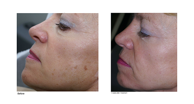 Westmont Brown Spot Removal - IPL Treatment