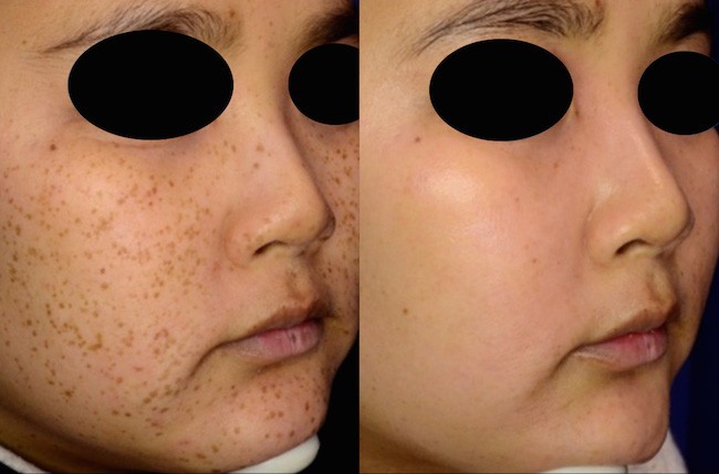 Before &amp; After Photos | Laser Aesthetic Center