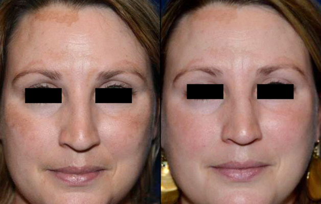 Find Melasma Treatment that Actually Works | Laser ...