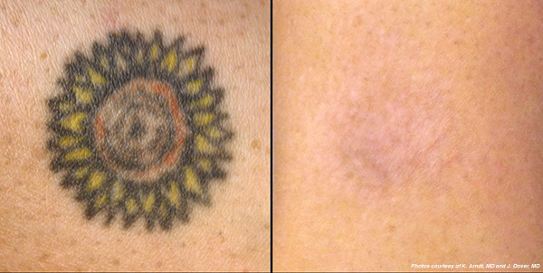 Hinsdale PicoSure Laser Tattoo Removal | Laser Aesthetic ...