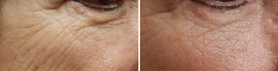 microneedling before and after
