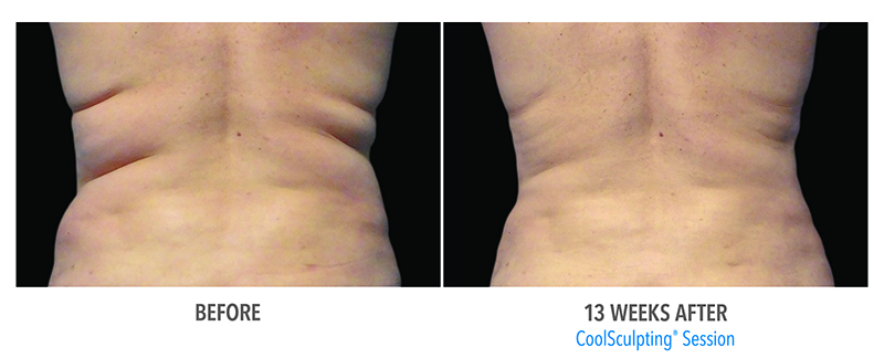 before and after Hinsdale CoolSculpting body contouring