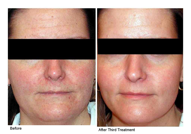 Hinsdale laser genesis before and after