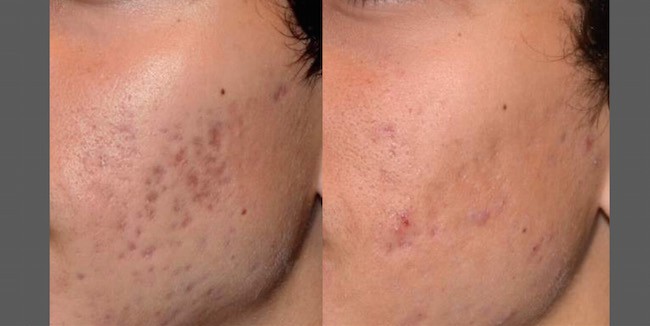 Naperville PicoSure laser acne scar treatment