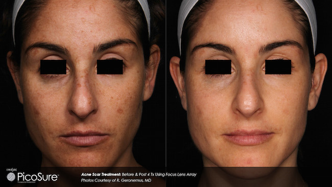 PicoSure Focus before and after