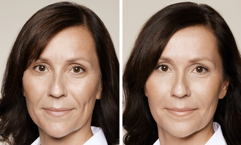 Hinsdale restylane before and after