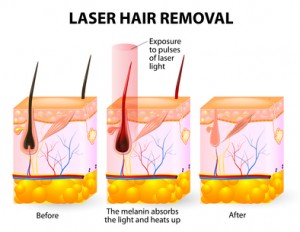 Laser hair removal downers grove
