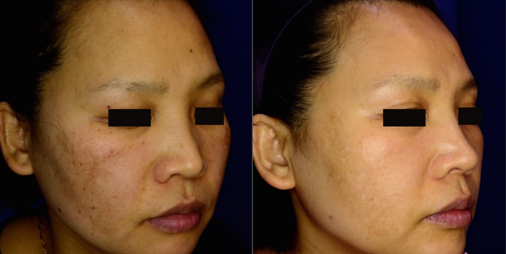 Wheaton laser acne scar removal