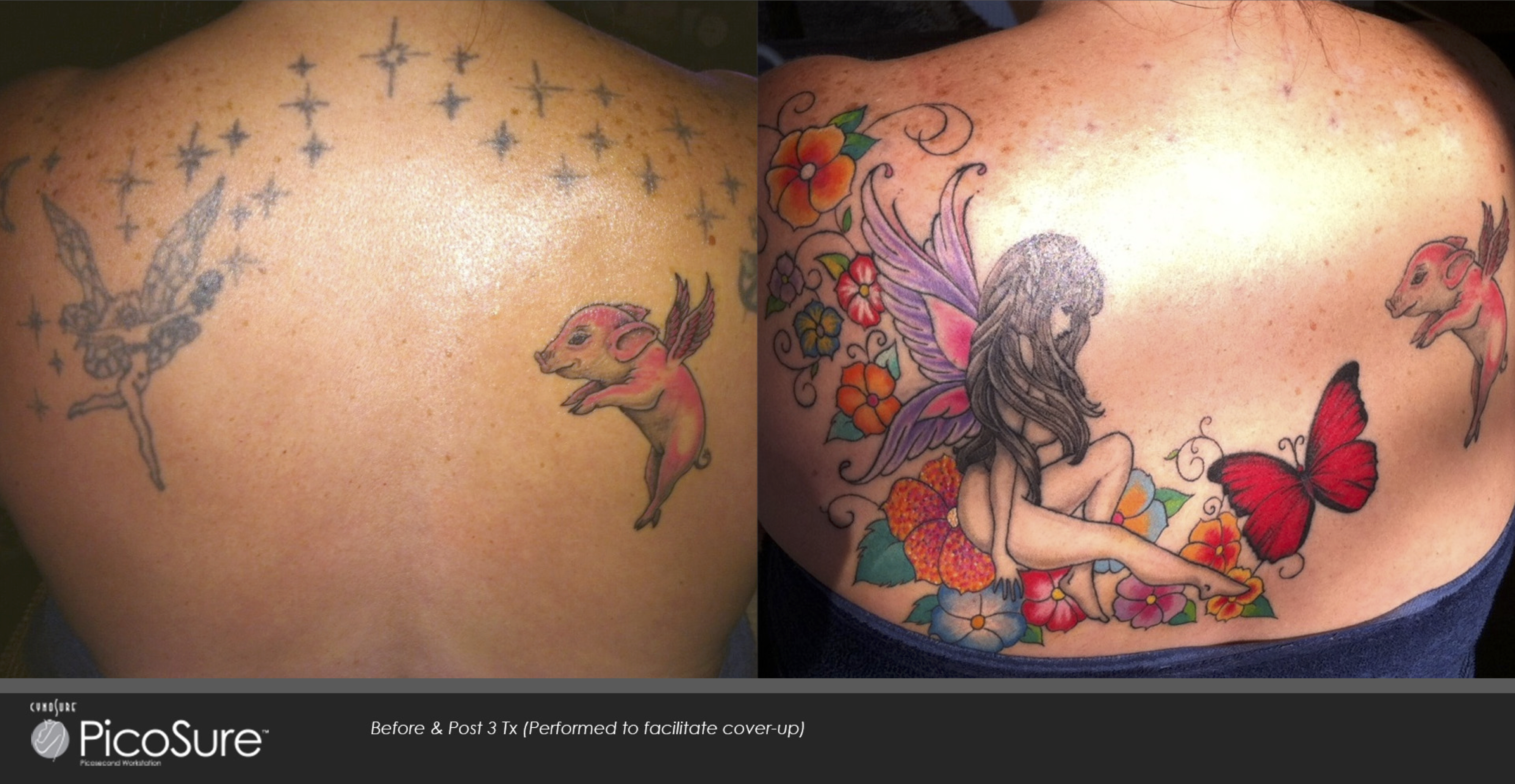 Best Tattoo Cover-Up | Orland Park Laser Tattoo Removal