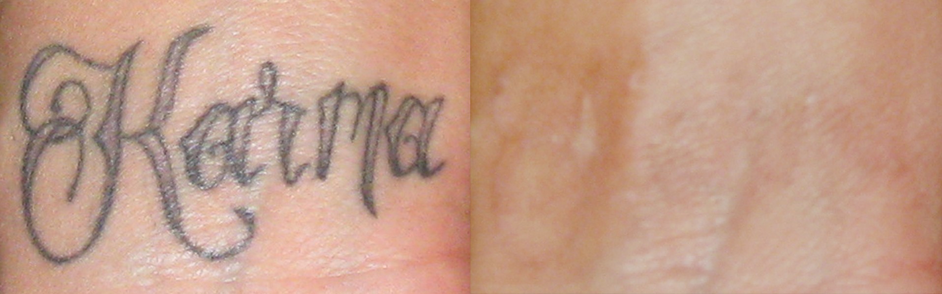 Downers Grove Laser Tattoo Removal