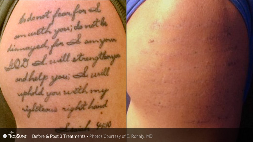 The Best Laser for Your Tattoo | Laser Aesthetic Cetner