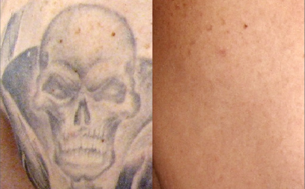 Wheaton laser tattoo removal