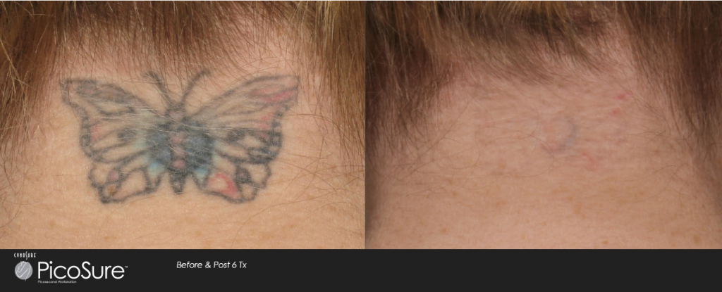 Lombard laser tattoo removal