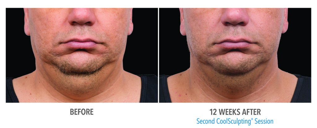 before and after Hinsdale CoolSculpting