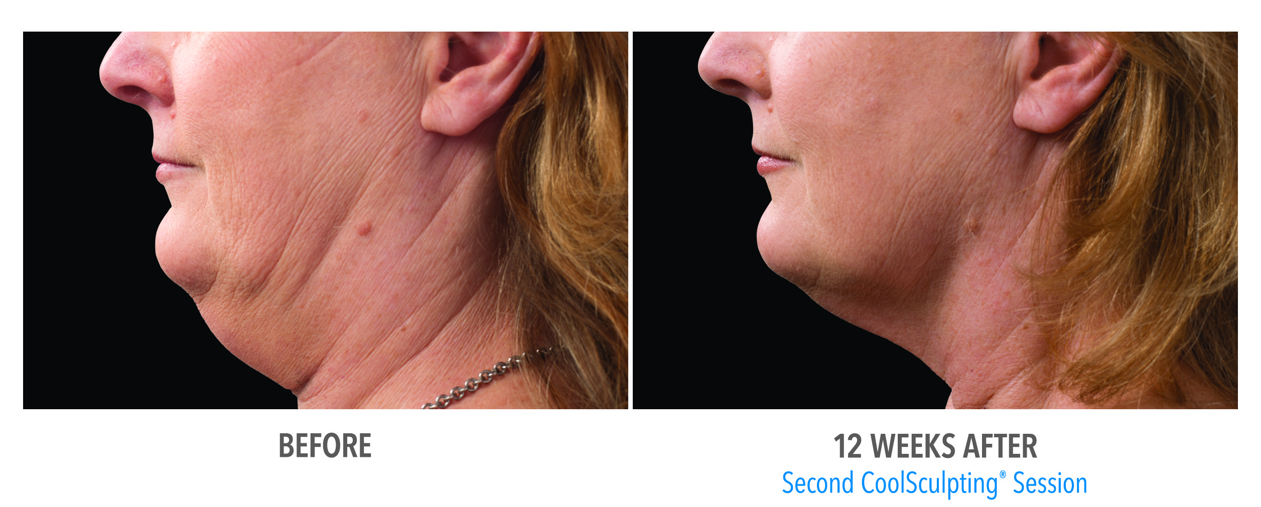 Hinsdale CoolSculpting double chin