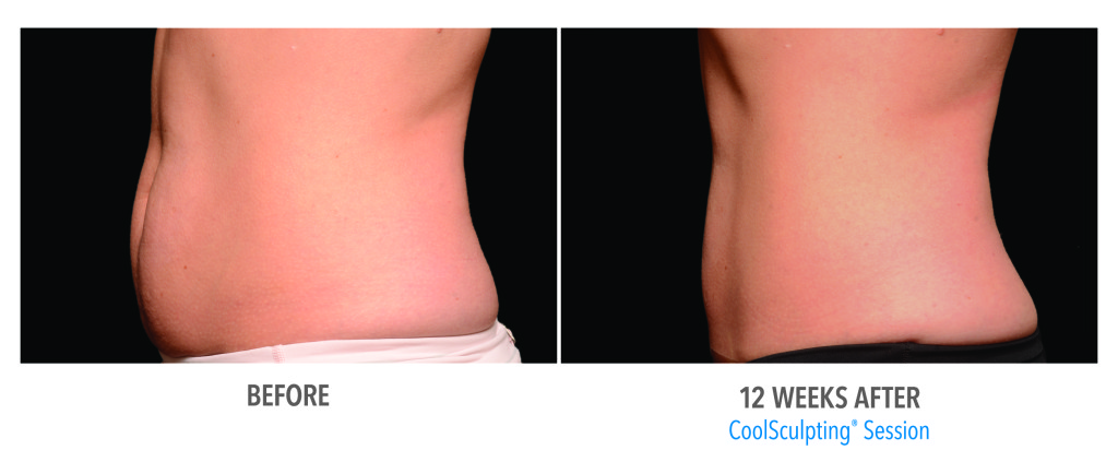 before and after Hinsdale coolsculpting