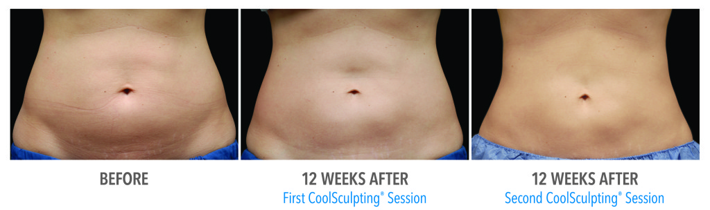 before and after Hinsdale coolsculpting