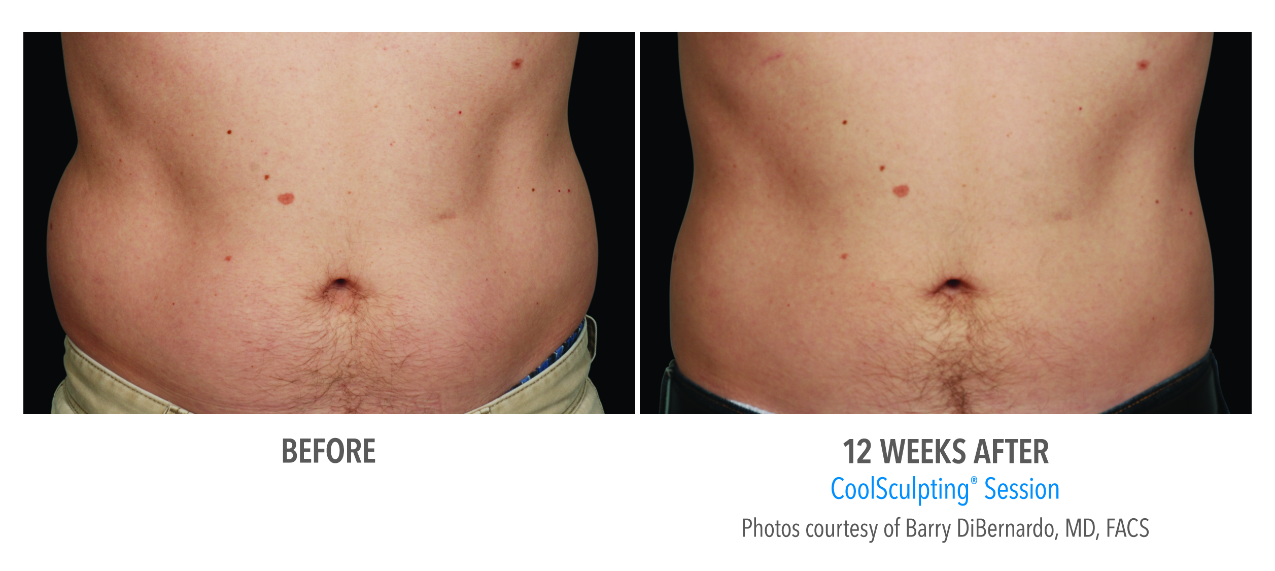 Your CoolSculpting Timeline | Aesthetic Center