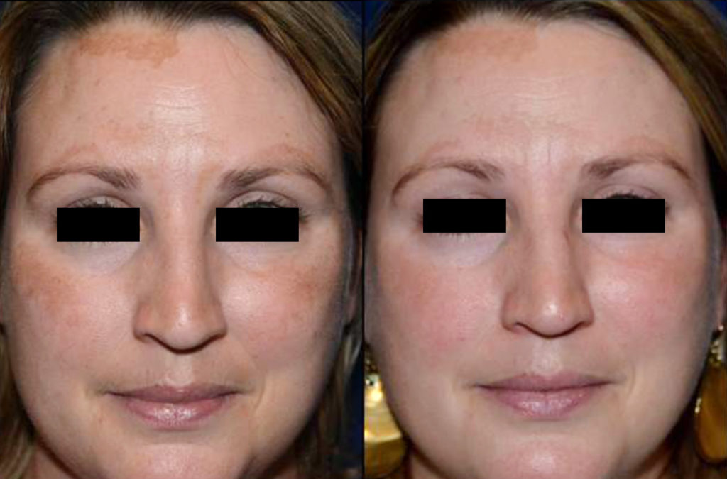 Find Melasma Treatment that Actually Works | Laser ...