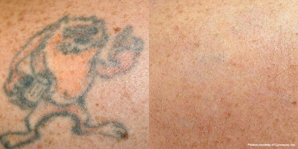 Hinsdale laser tattoo removal