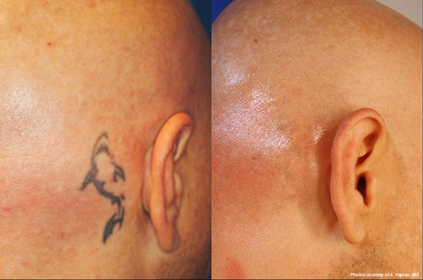 Hinsdale laser tattoo removal