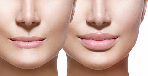Before and after lip filler injections. Lips closeup over white
