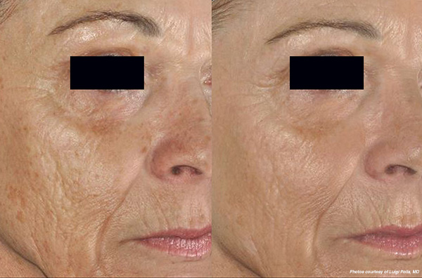 Hinsdale laser skin resurfacing before and after