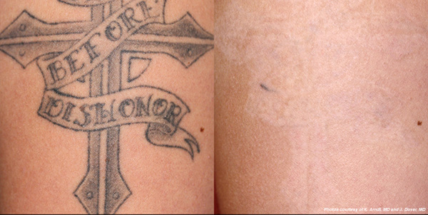 Step by Step Laser Tattoo | Laser Aesthetic