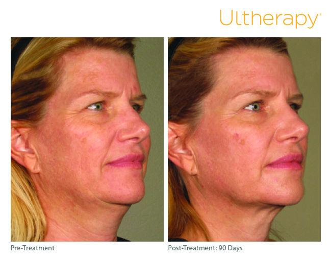 Hinsdale Ultherapy before and after