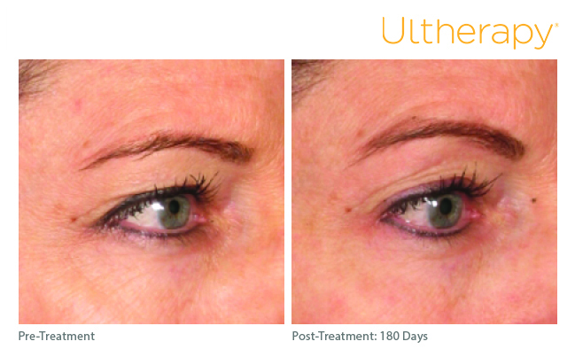 Hinsdale Ultherapy before and after