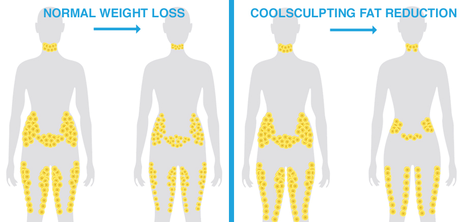 diagram showing Hinsdale CoolSculpting eliminating fat cells