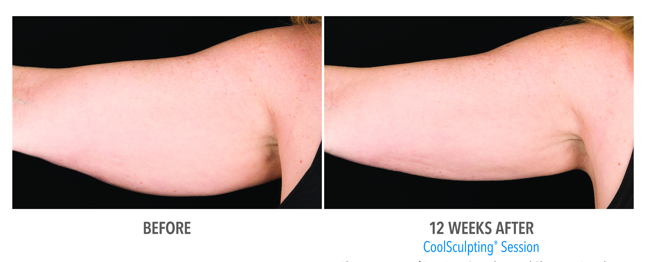 Coolsculpting Arm Before And After