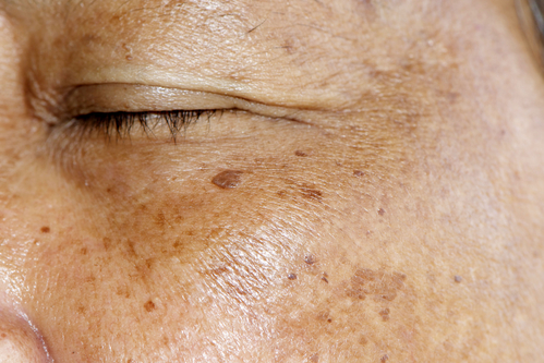 close up of person's face with brown spots