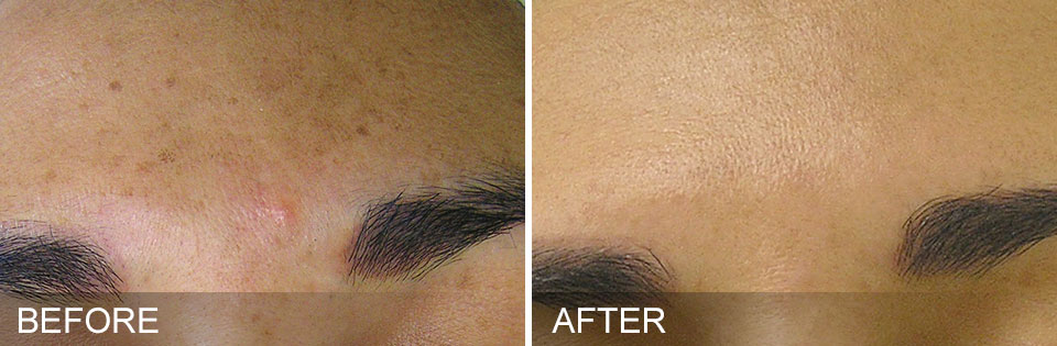 Hydrafacial before and after Brown Spots