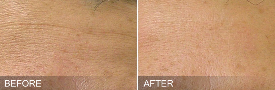 Hydrafacial before and after fine lines