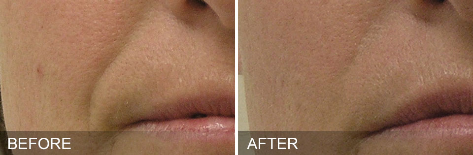 Hydrafacial before and after wrinkles