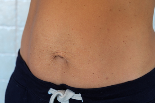 woman's postpartum belly