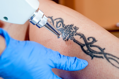 laser treatment removal for a tattoo on calf