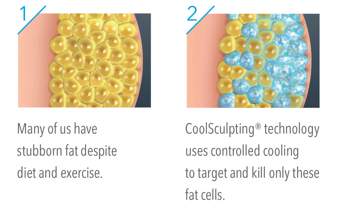Hinsdale CoolSculpting process