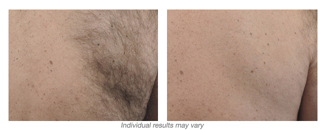before and after Hinsdale laser hair removal
