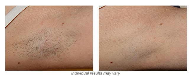 before and after Hinsdale laser hair removal