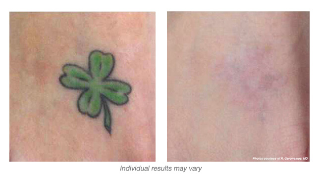 before and after Hinsdale laser tattoo removal