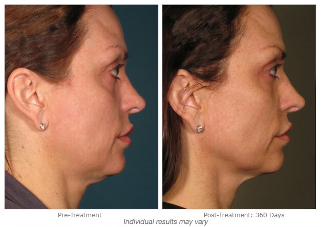 before and after Hinsdale Ultherapy
