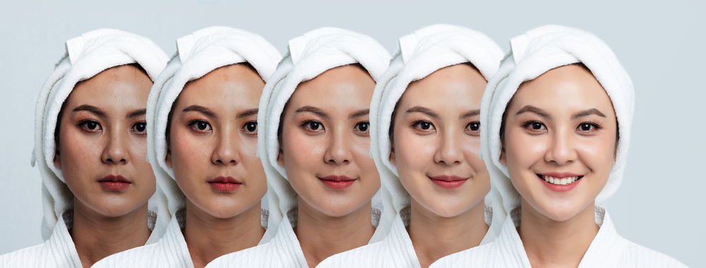Correcting Skin Discoloration