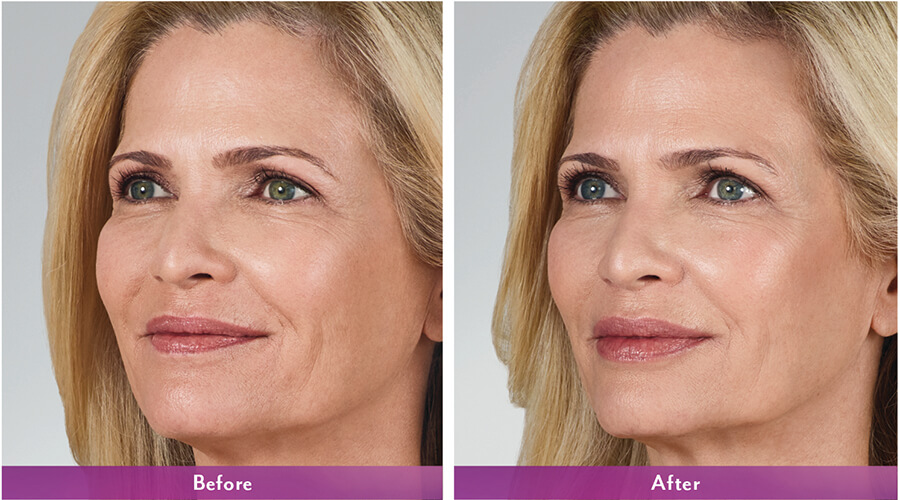 before and after juvederm