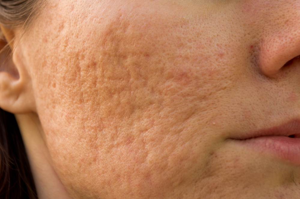 Does Dermaplaning Help With Acne Scars?