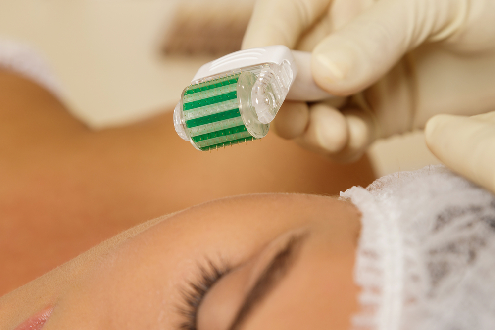 When to expect results from microneedling