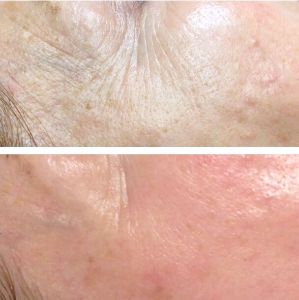 microneedling before and after