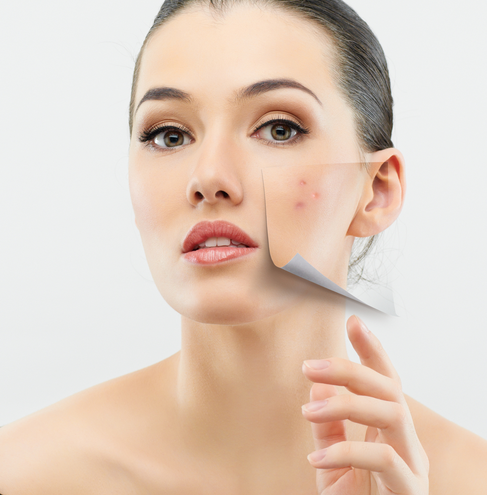 Hormonal acne treatments
