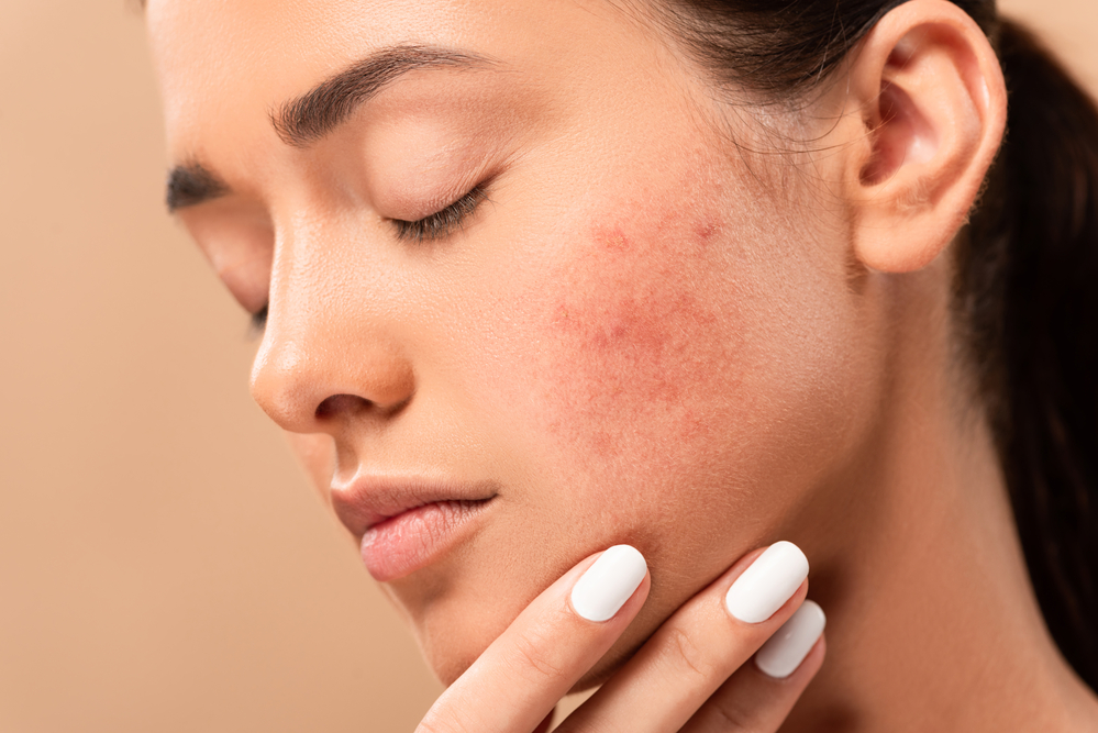 woman touching face with acne scars